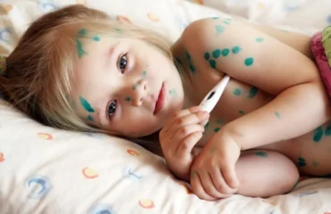 Вітряна віспа