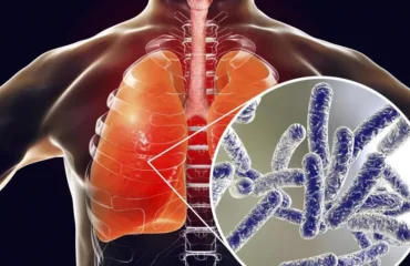 Туберкульоз