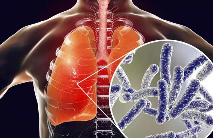 Туберкульоз